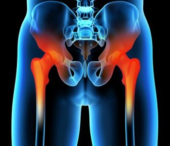 cirurgia-do-quadril cirurgia-do-quadril
